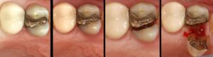 How Long Do Teeth Fillers Last