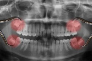 Benefits of Keeping Wisdom Teeth